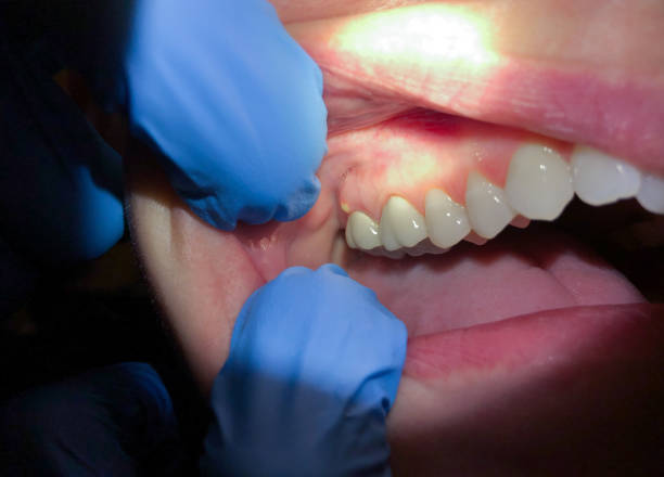 Best Emergency Dental Care for Broken or Chipped Teeth in Arthur, IL