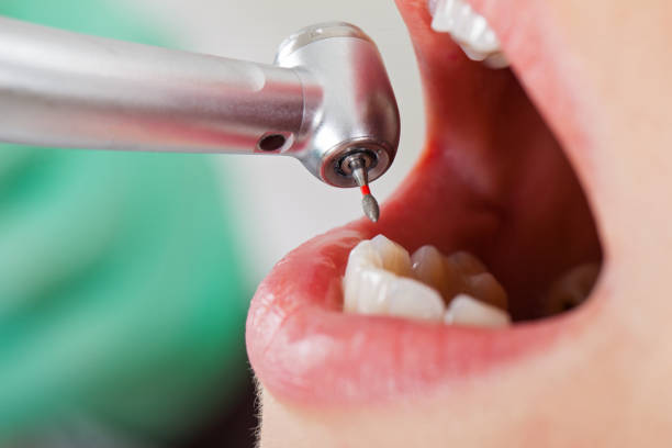 Best Emergency Wisdom Teeth Removal in Arthur, IL
